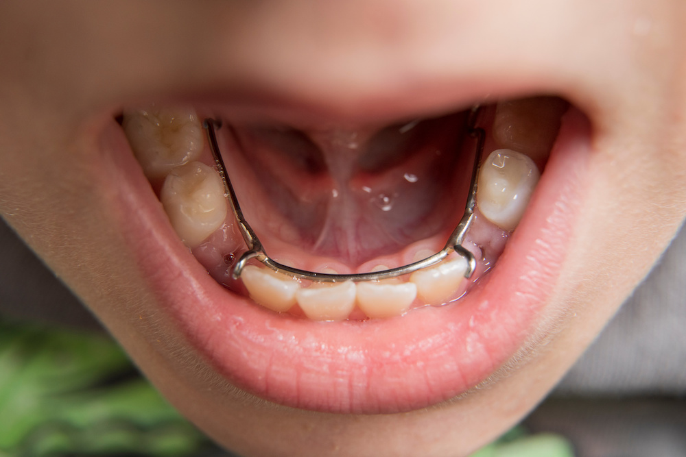 Are Spacers Necessary for Baby Teeth? Campfire Pediatric Dentistry